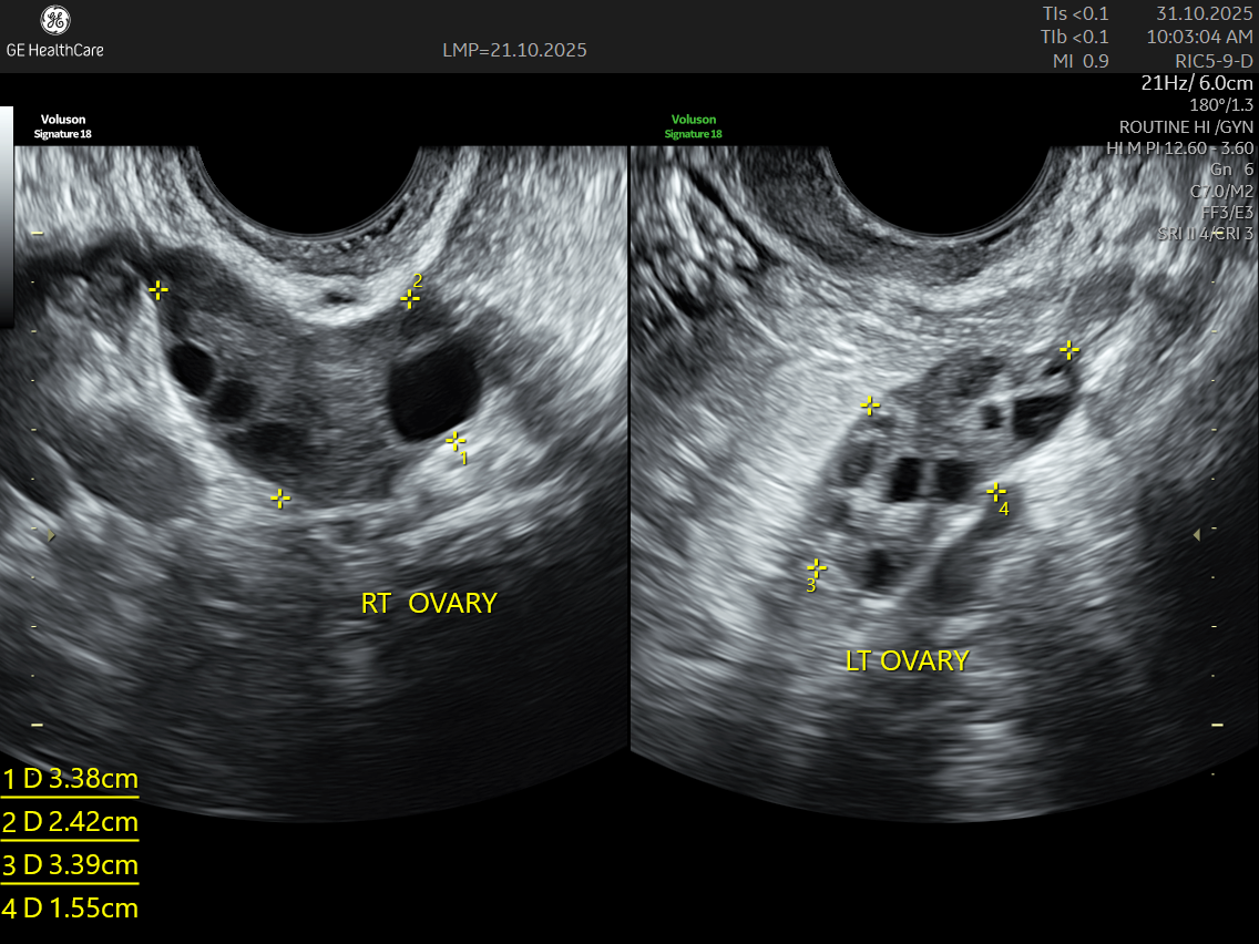 Advanced Gynecological Ultrasound for PCOS – Dr. Rajiv Sinha